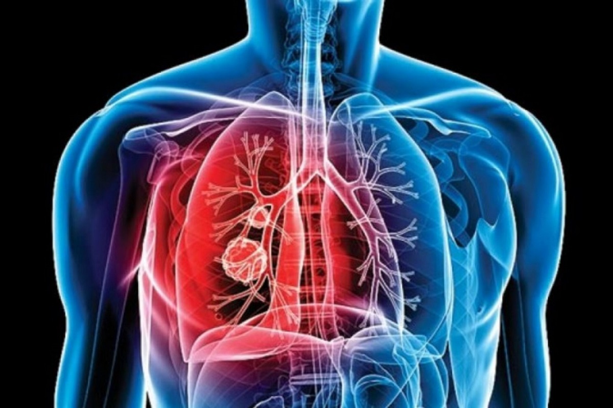 Φυματίωση: Μπορεί να μεταδοθεί με την αναπνοή