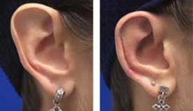 Μείωση του μήκους των αυτιών-Μειωτική ωτοπλαστική