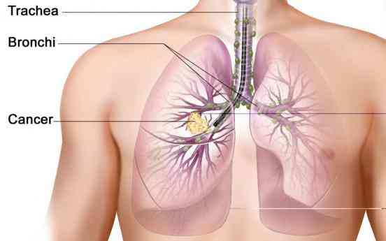 Ασθενείς με ALK-θετικό μη-μικροκυτταρικό καρκίνο του πνεύμονα που έλαβαν θεραπεία με ceritinib (ZykadiaTM) έζησαν  κατά μέσο όρο 18 μήνες χωρίς εξέλιξη της νόσου