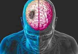 Το εγκεφαλικό γερνάει το μυαλό κατά 8 χρόνια