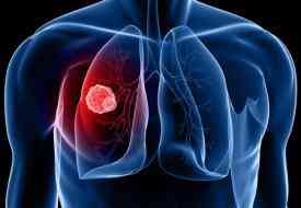 Υδατάνθρακες: Είναι το νέο τσιγάρο όσον αφορά στον καρκίνο του πνεύμονα;