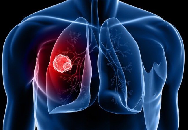 Καρκίνος του πνεύμονα: Τα πολλά λιπαρά προκαλούν τη νόσο