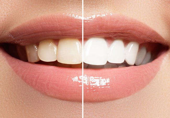 Δόντια: Οι 3 παράγοντες που αλλάζουν το χρώμα τους