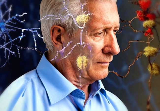 Αϋπνία: Είναι πρώιμη ένδειξη Αλτσχάιμερ;