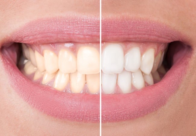 Δόντια: Αυτές είναι οι 3 τροφές που τα κιτρινίζουν