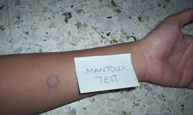 Καταργείται η διενέργεια Mantoux στα παιδιά του νηπιαγωγείου