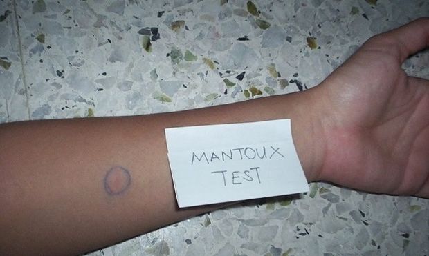 Καταργείται η διενέργεια Mantoux στα παιδιά του νηπιαγωγείου Καταργείται η διενέργεια Mantoux στα παιδιά του νηπιαγωγείου