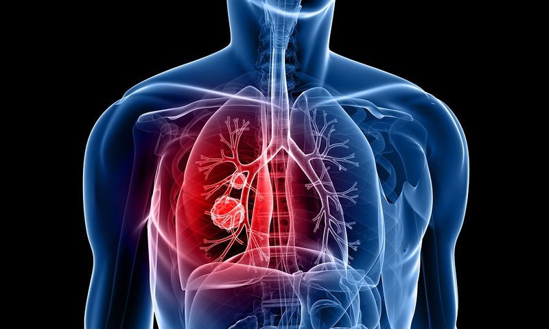 Ο συνδυασμός του nivolumab με χαμηλή δόση ipilimumab μειώνει τον κίνδυνο εξέλιξης της νόσου ή θανάτου κατά 42% έναντι της χημειοθεραπείας σε ασθενείς πρώτης γραμμής με καρκίνο του πνεύμονα