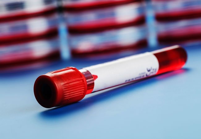 Όσοι έχουν αυτή την ομάδα αίματος έχουν υπερδιπλάσιο κίνδυνο να πεθάνουν από αιμορραγία