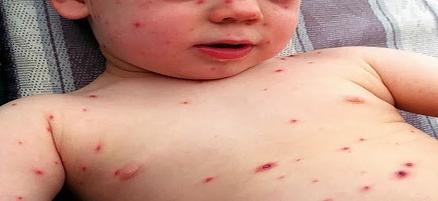 ΕΟΔΥ: Μόλις 28 κρούσματα και κανένας θάνατος από ιλαρά για το 2019