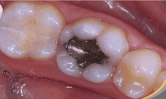 Υπό αυστηρούς περιορισμούς η χρήση οδοντιατρικών αμαλγαμάτων από τους οδοντίατρους