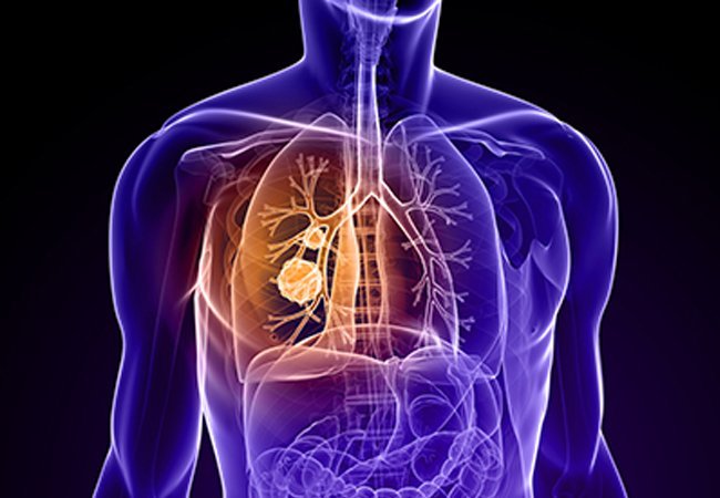 Καρκίνος των πνευμόνων: Η μακροχρόνια χρήση φαρμάκων αυξάνει τον κίνδυνο