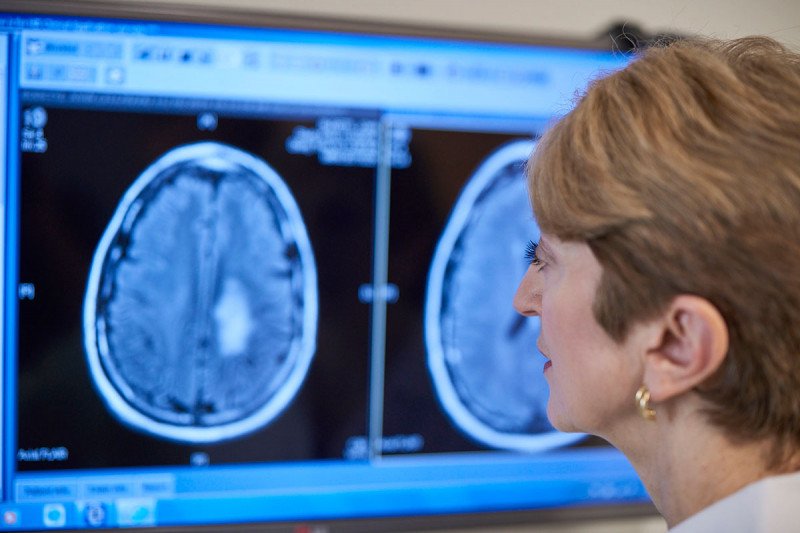 Καρκίνος του εγκεφάλου: Οι γυναίκες αντιδρούν καλύτερα στην χημειοθεραπεία από τους άνδρες