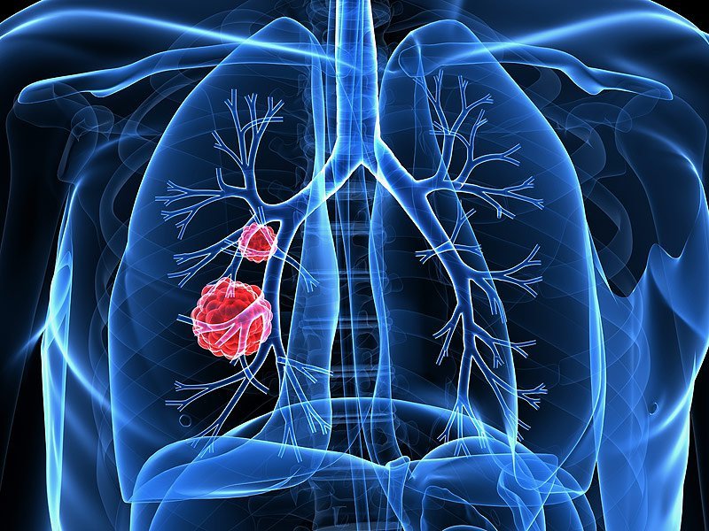 Καρκίνος του πνεύμονα: Οι 5 αιτίες που τον προκαλούν εκτός από το κάπνισμα;