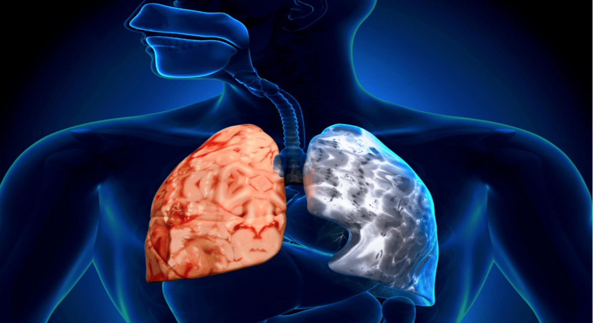 20 Νοεμβρίου: Παγκόσμια ημέρα κατά της Χρόνιας Αποφρακτικής Πνευμονοπάθειας