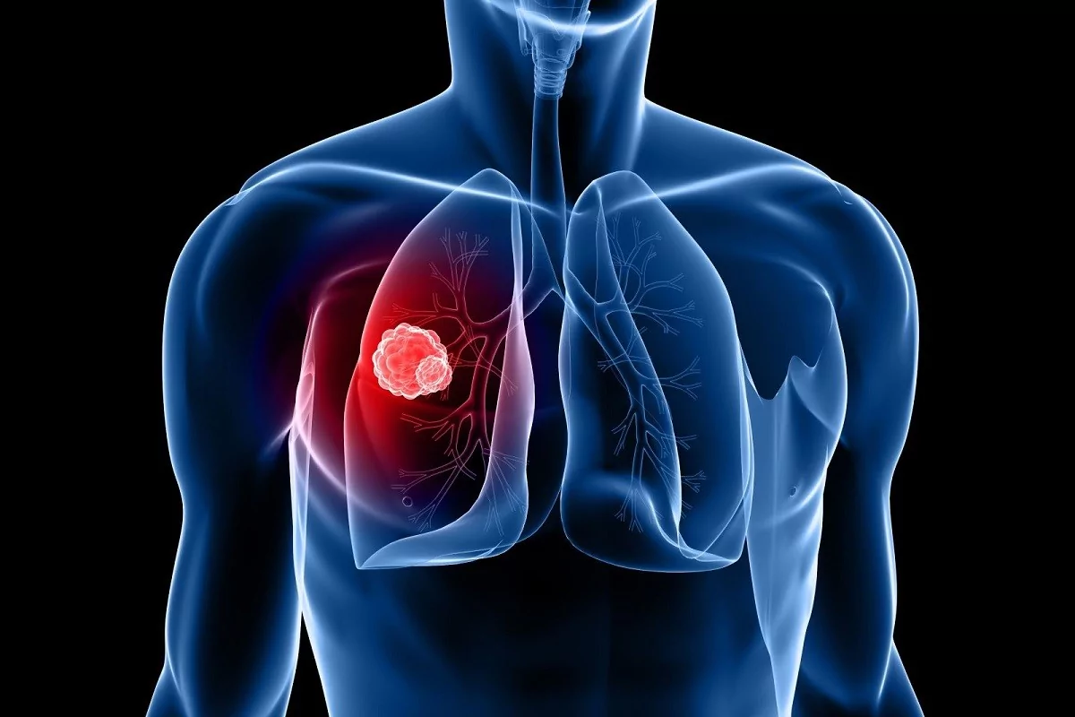 Καρκίνος του πνεύμονα: Ποιο διατροφικό συστατικό προστατεύει