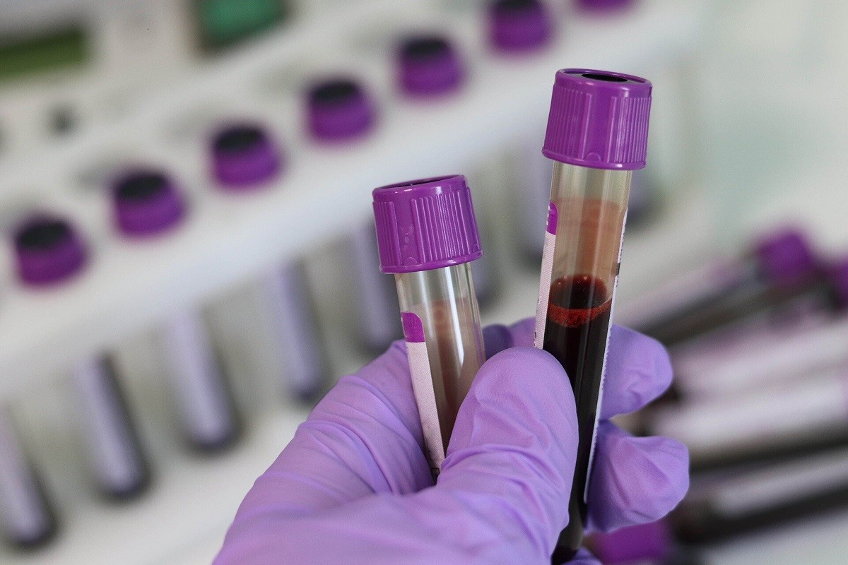εξέταση στο αίμα για να διαπιστωθεί εάν υπάρχει ουρικό οξύ
