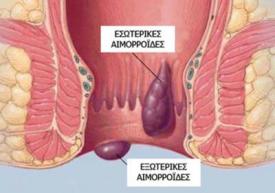 Αιμορροΐδες