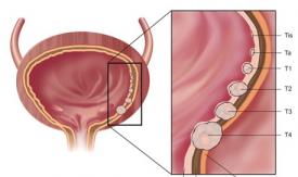 Όγκοι της ουροδόχου κύστης