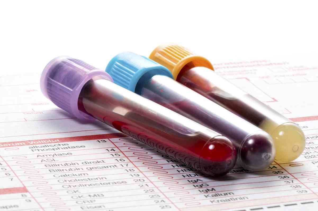 Εξετάσεις αίματος: Τι πρεπει και τι δεν πρέπει να τρώτε πριν