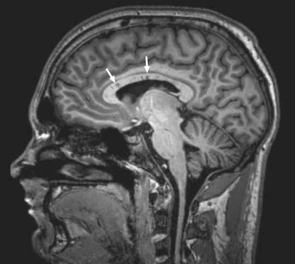 Μαγνητική εγκεφάλου ενός ασθενή με Σύνοδρομο Σούζακ