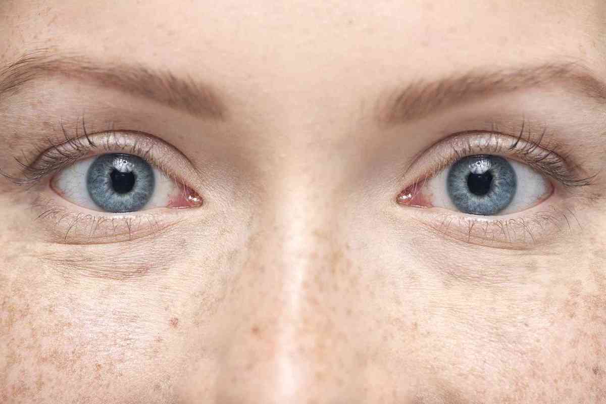 Ευλογιά των πιθήκων: Πώς μπορεί να επηρεάσει τα μάτια