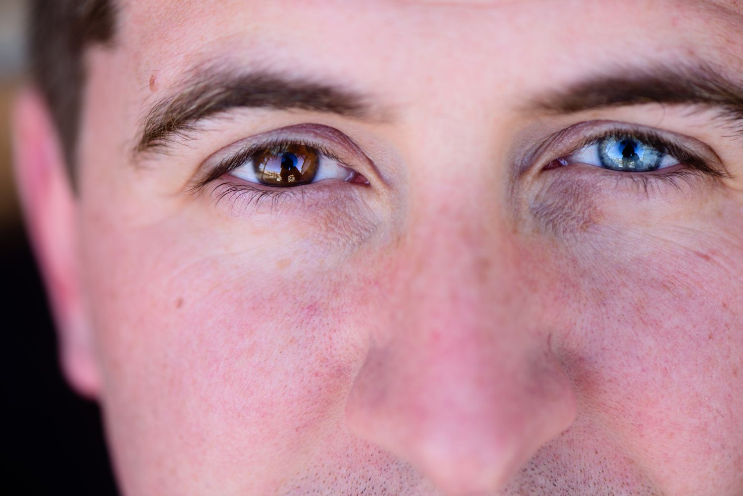 Μάτια: Γιατί κάποιοι έχουν διαφορετικό χρώμα σε κάθε μάτι