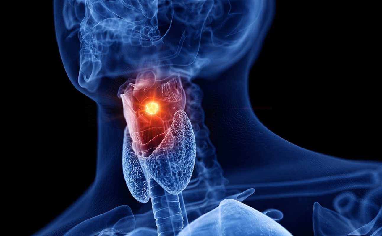 Καρκίνος: Μπορεί η κακοσμία στο στόμα να είναι σύμπτωμα;
