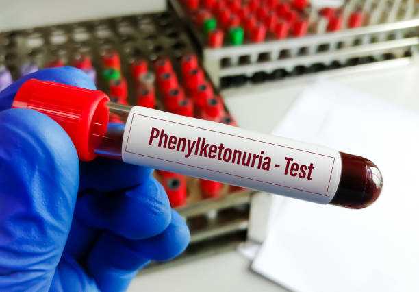 Η Φαινυλκετονουρία (PKU) συγκεντρώνει το ενδιαφέρον ειδικών σε Ελλάδα και Ευρώπη